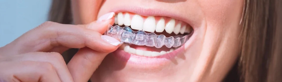 A patient putting in her clear aligners
