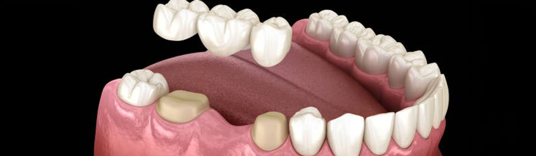 A 3-D model of a dental bridge