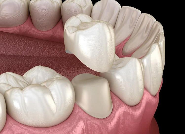 A 3D model of a dental crown being placed