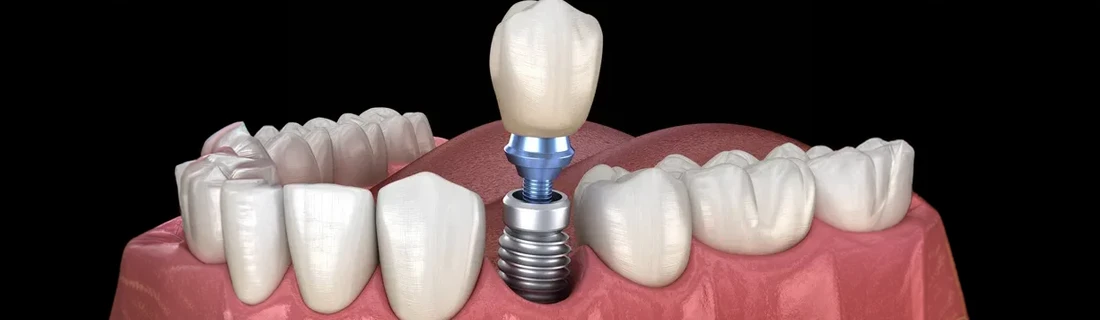 A 3-D model of a dental implant
