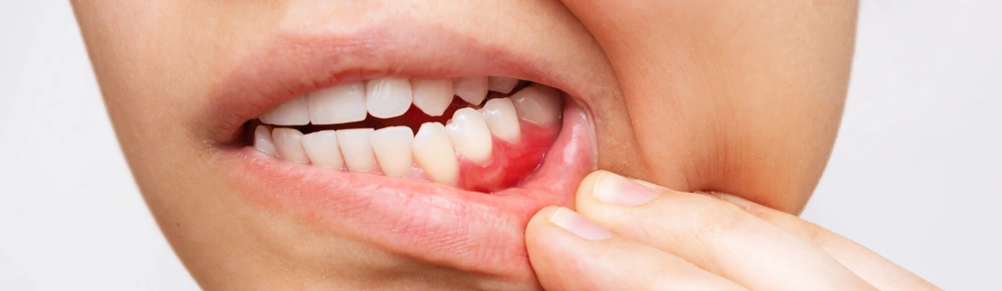 A patient pulling back their lip to show inflammation and gum disease