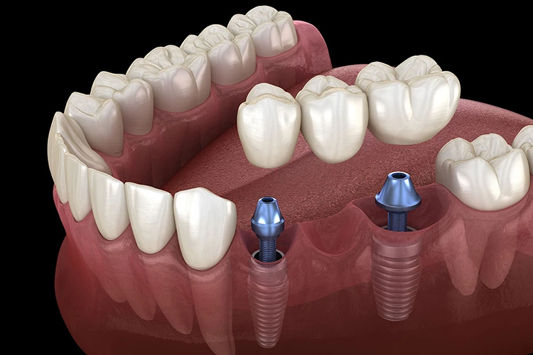 A 3D model of dental implants being placed