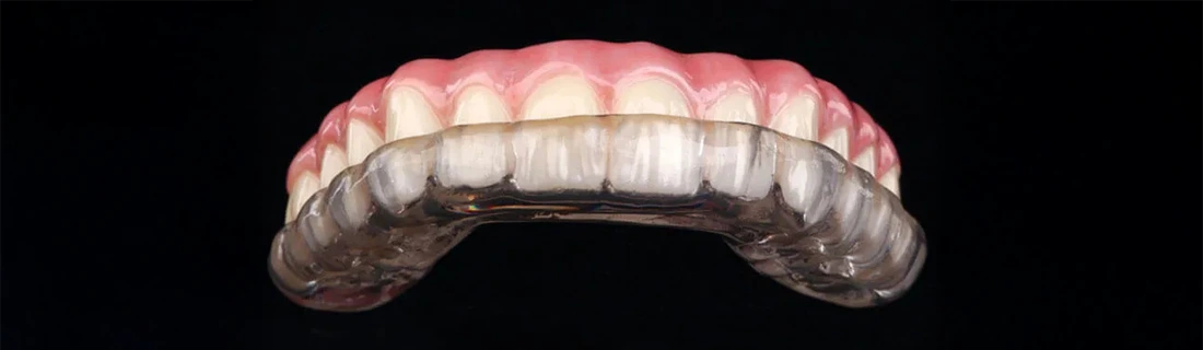 A 3D model of a mouth guard on teeth