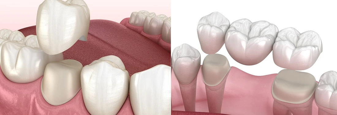 A 3D model showing restorative dentistry services