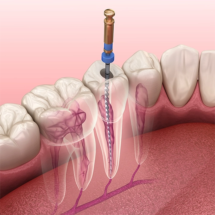 A 3D model of root canal treatment being performed on a tooth