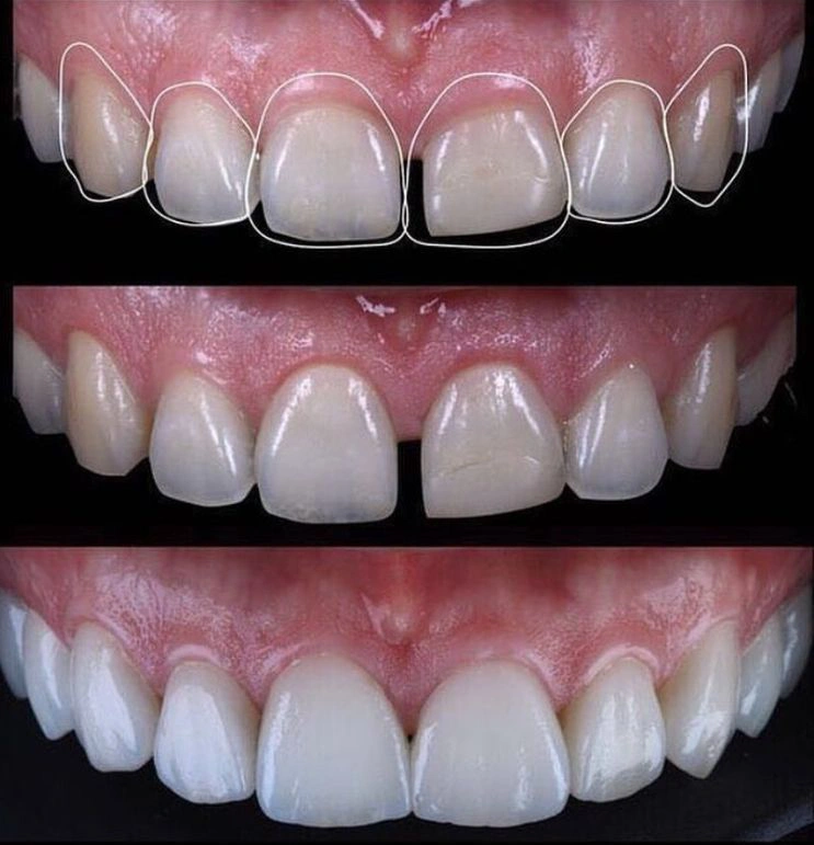 Image showing teeth comparison before and after veneers