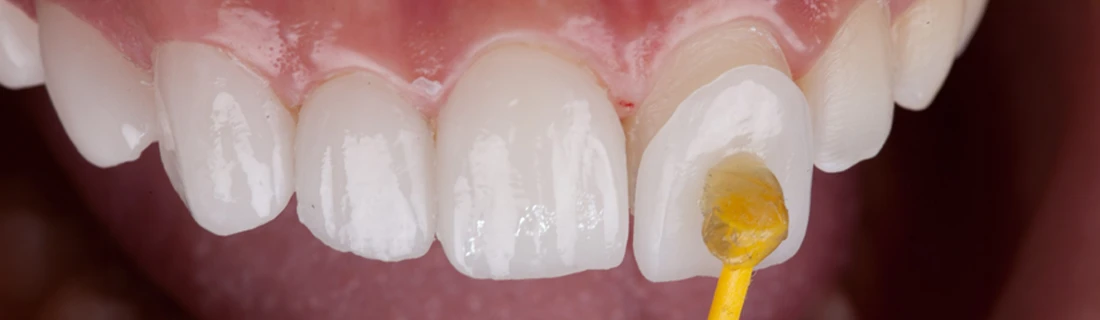 A veneer being applied to a patient's tooth
