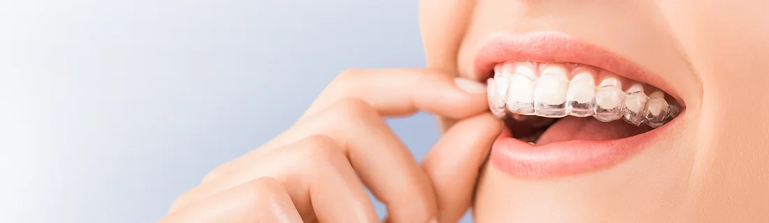 Dentist Aurora IL Woman Putting in Clear Aligners